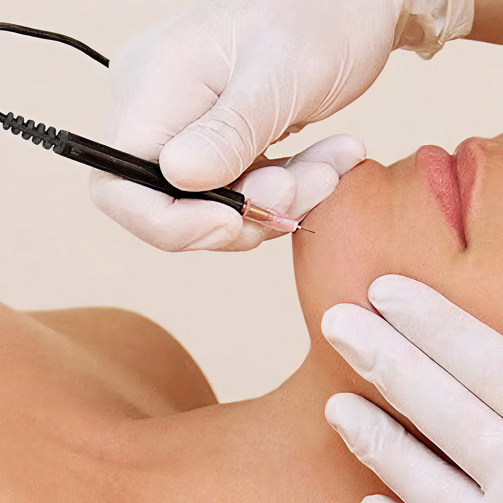 Electrolyse : arme efficace contre l'hirsutisme lié au SOPK ?